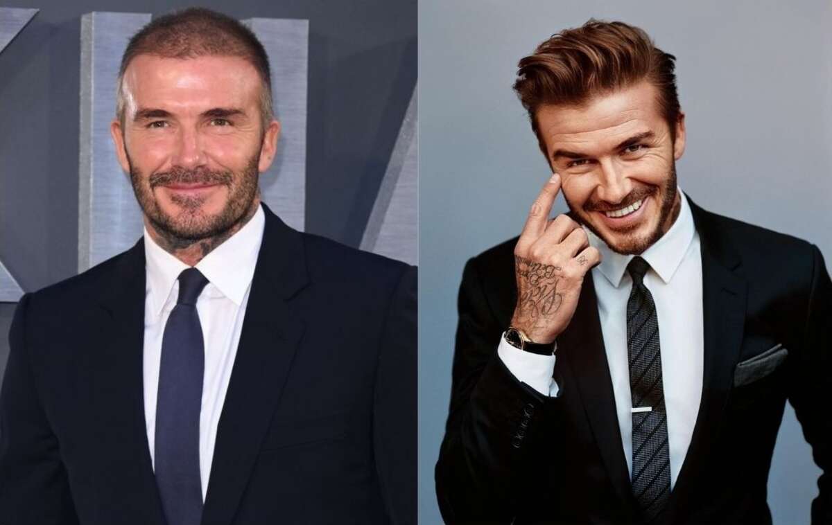 David Beckham Hair Transplant