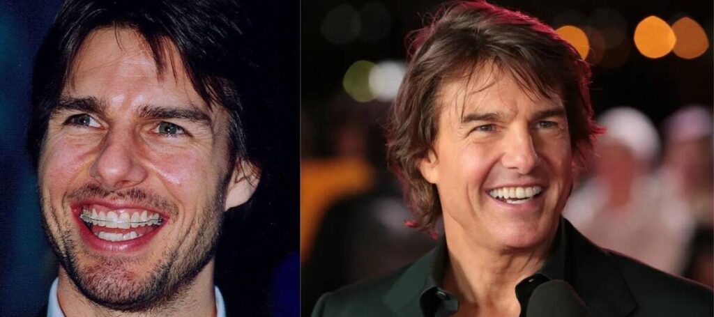 Tom Cruise Teeth Before and After